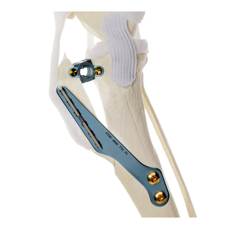 Anatomical knee model showing a TTA implant